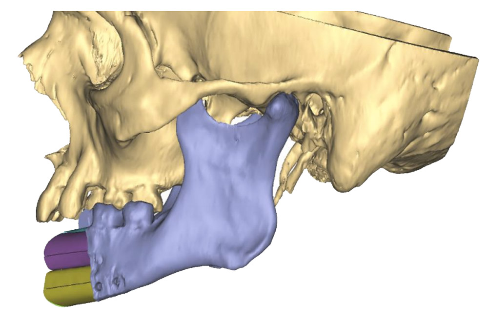 VSP for Patient-Specific Reconstructive Microsurgery Case Study Figure 5a